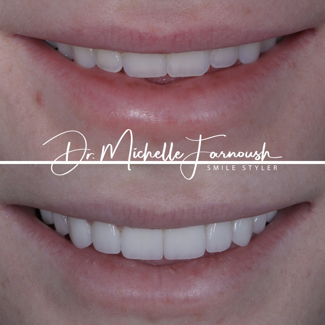 Complete case with 10 ultra conservative prepless veneers for an amazing smile
