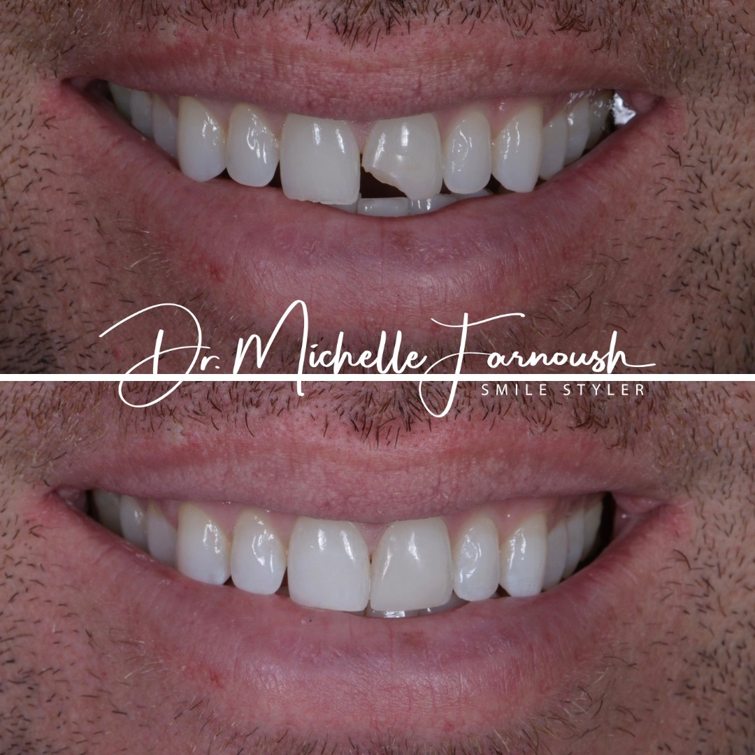 Closeup of how to repair a chipped front tooth and maintain smile aesthetics