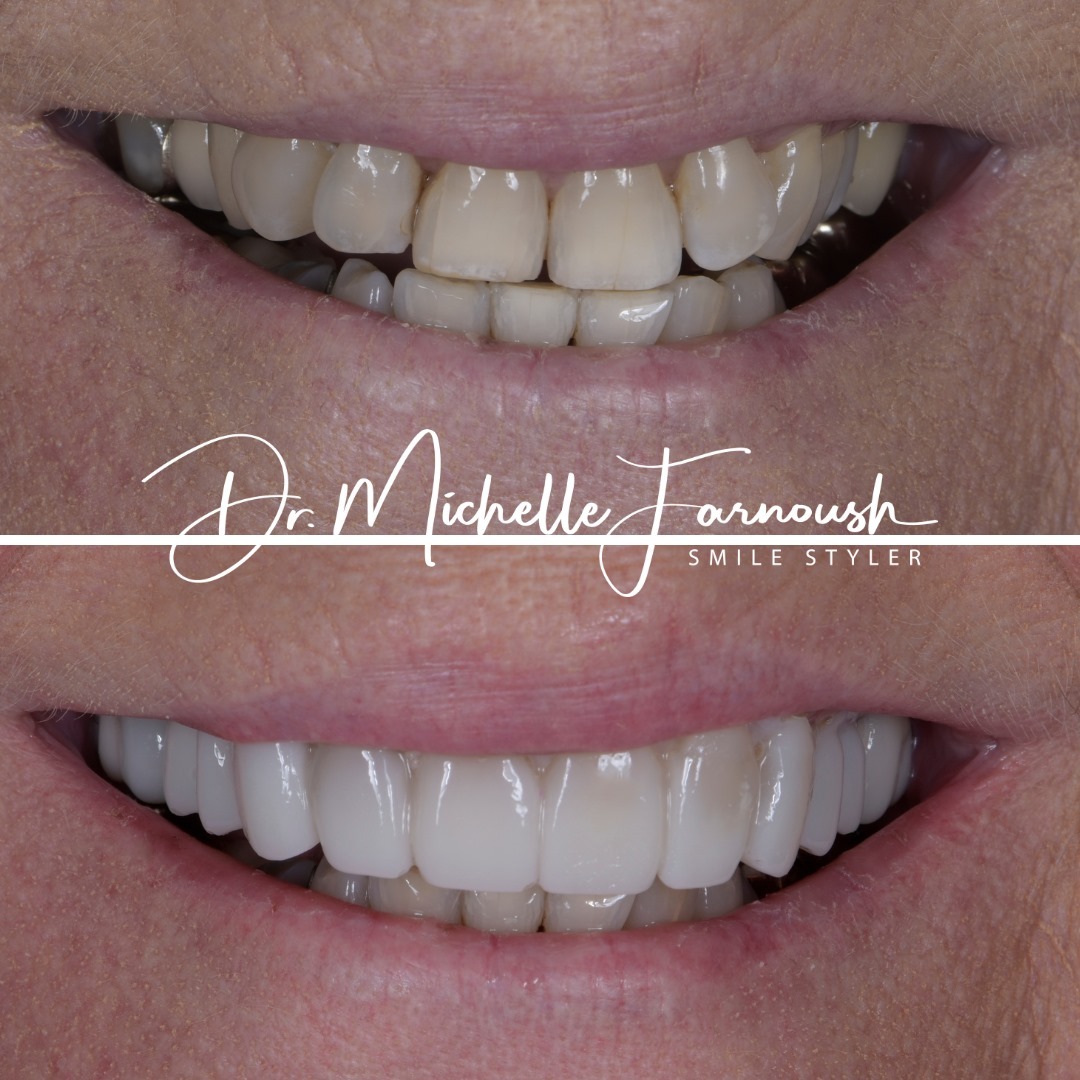 Real patient with a complete smile makeover