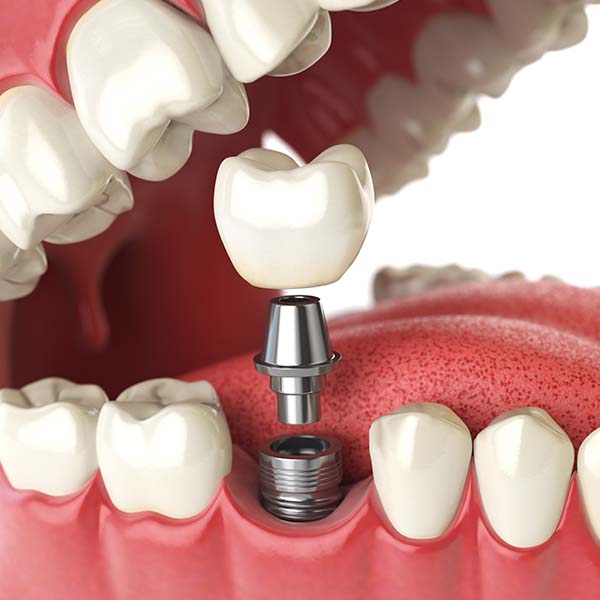 An image showing how a dental implant is placed into the mouth to look natural with your teeth 