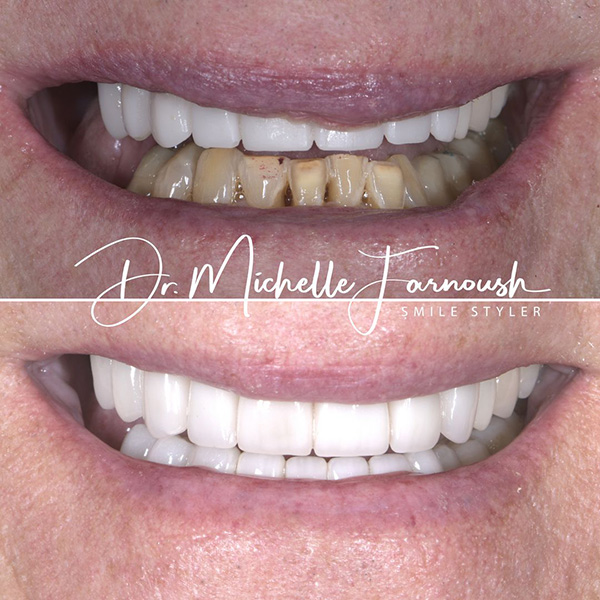 daVinci™ Veneers Before and After