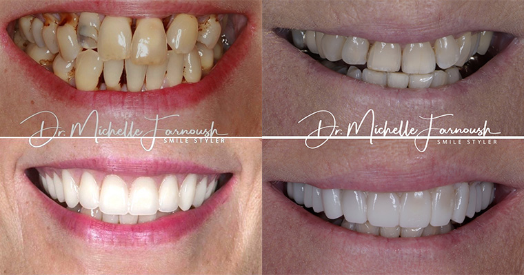 Smile Design: The Art of Crafting the Perfect Smile