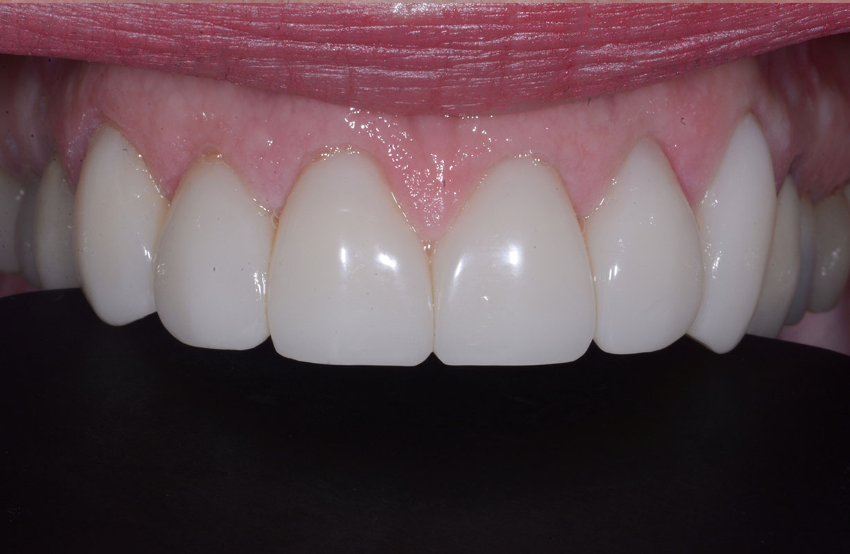  BioClear restoration of existing tooth structure - After