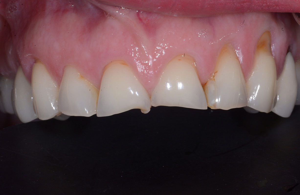  BioClear restoration of existing tooth structure - Before 