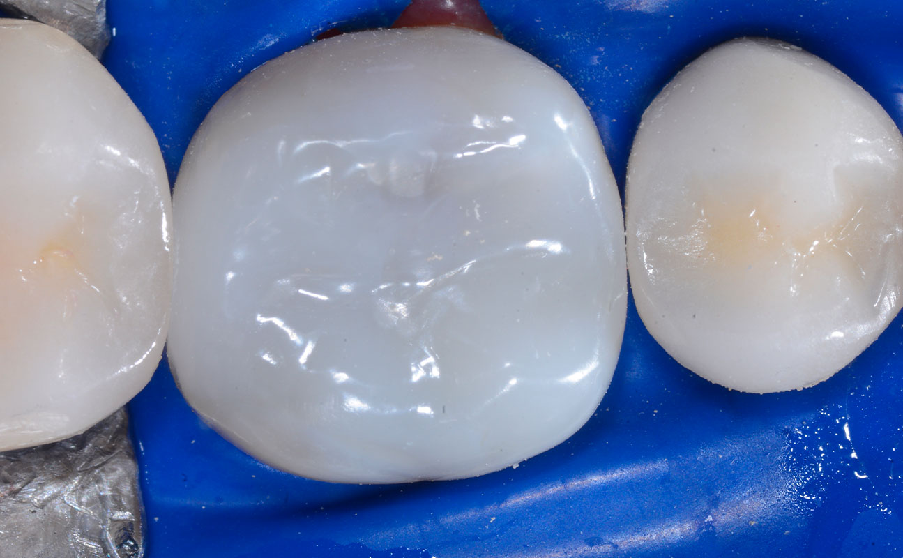 Bioclear Posterior Restorations - After