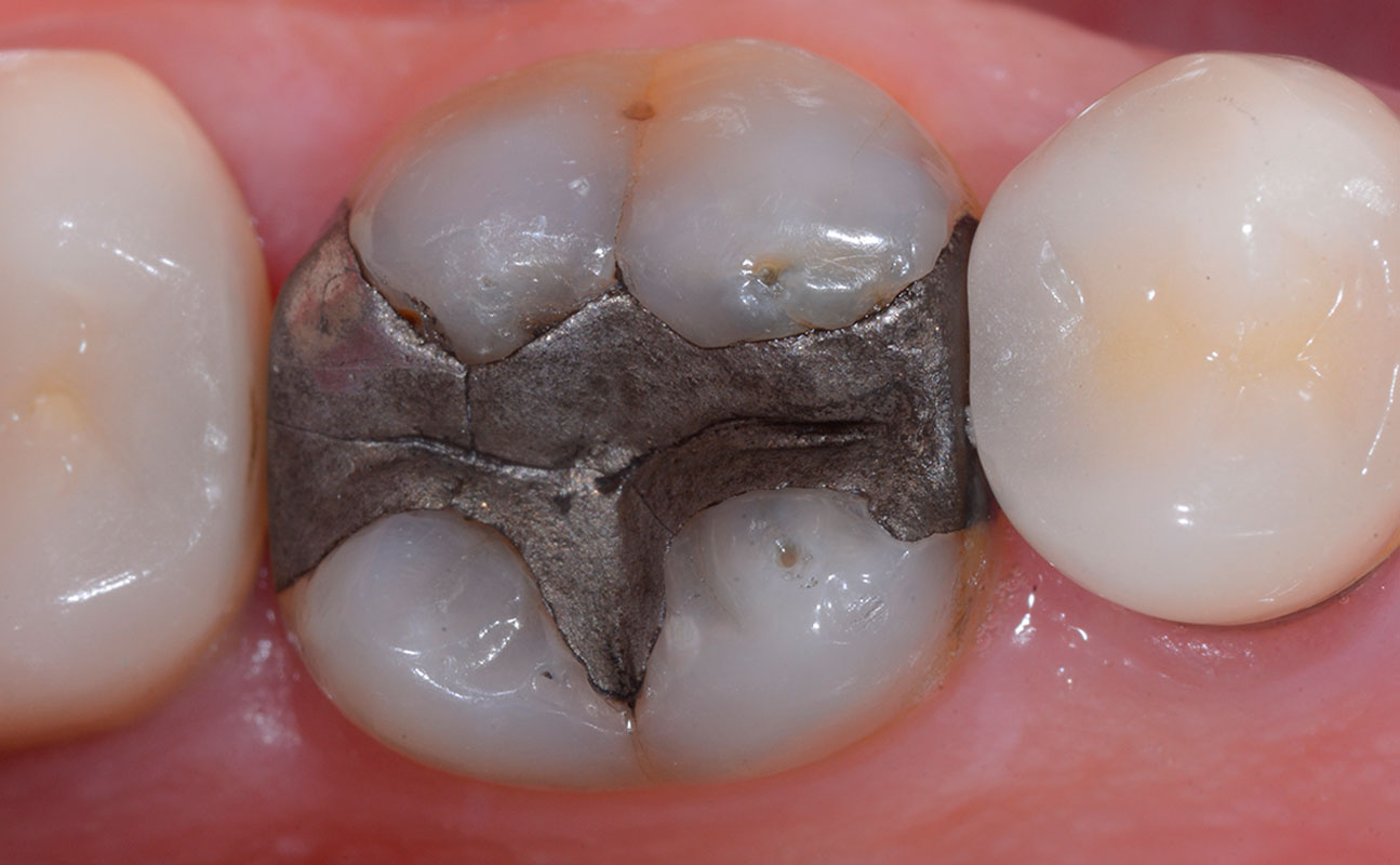 Bioclear Posterior Restorations - Before 