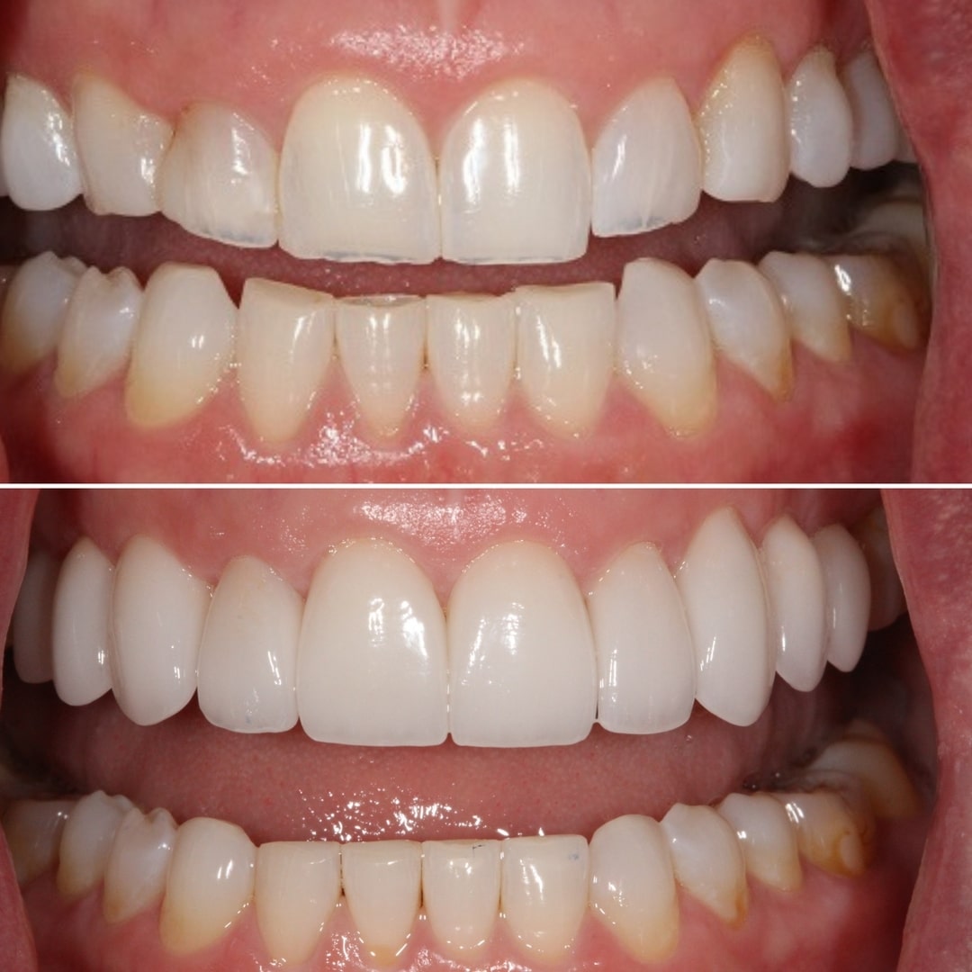 Biomimetic Dentistry Newport Beach Before and After