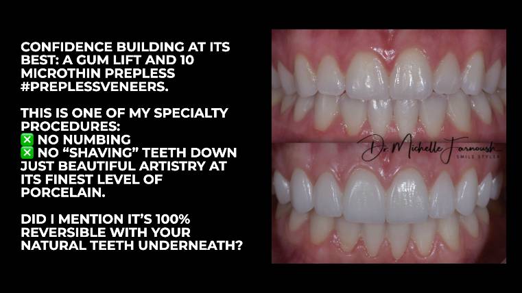 Transform Your Smile with Confidence: Discover the Power of Veneers!